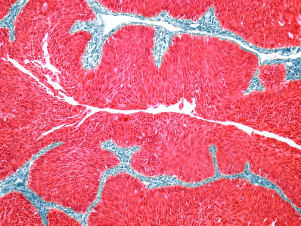 Light micrograph of a section through a transitional cell carcinoma (TCC, cancer) of the bladder wall. | Image source: Getty Images